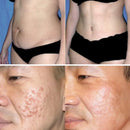 Scar Remove™ Removedor de Cicatrizes, Estrias e Marcas na Pele - |COMPRE 1 LEVE 2| + Frete Grátis