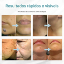 O Fim da Vergonha: Remova Sinais, Verrugas e Manchas Escuras com um Único Clique — Antes que Elas se Multipliquem.