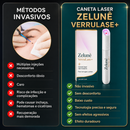 O Fim da Vergonha: Remova Sinais, Verrugas e Manchas Escuras com um Único Clique — Antes que Elas se Multipliquem.