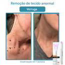 O Fim da Vergonha: Remova Sinais, Verrugas e Manchas Escuras com um Único Clique — Antes que Elas se Multipliquem.